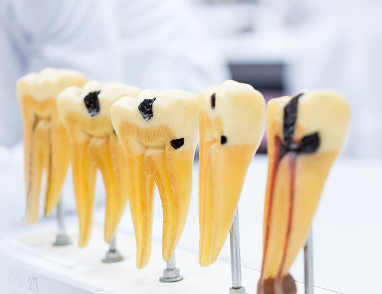 茗荷谷駅徒歩2分の歯医者｜佐藤歯科医院のむし歯治療