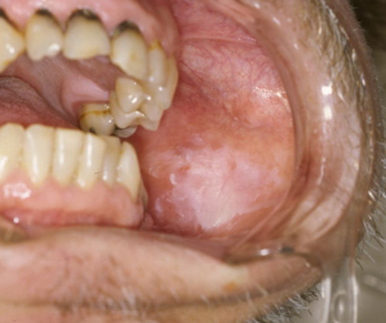 茗荷谷駅徒歩2分の歯医者｜佐藤歯科医院のお口の中のデキモノ