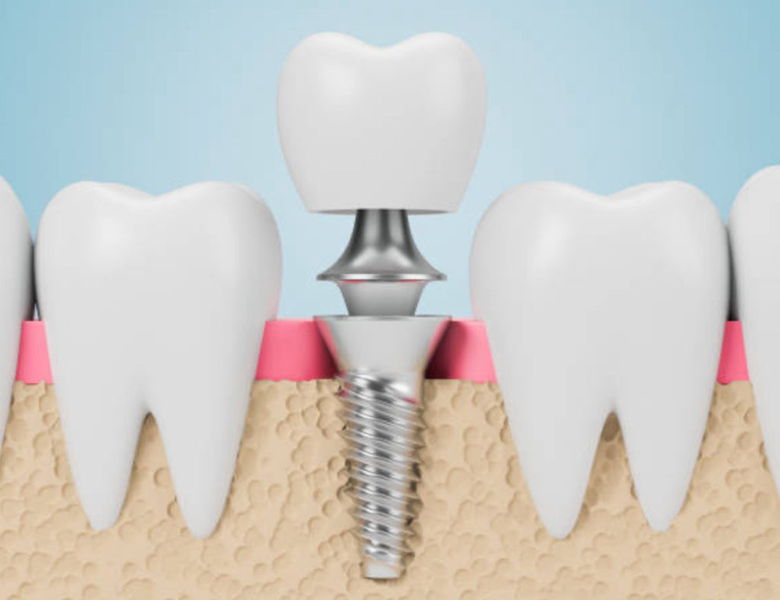 茗荷谷駅徒歩2分の歯医者｜佐藤歯科医院のインプラント治療