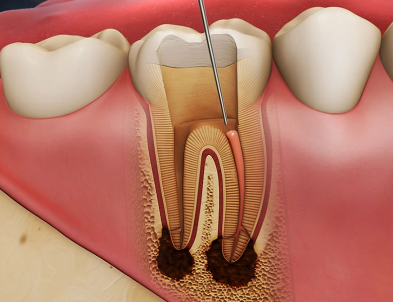 茗荷谷駅徒歩2分の歯医者｜佐藤歯科医院の根管治療