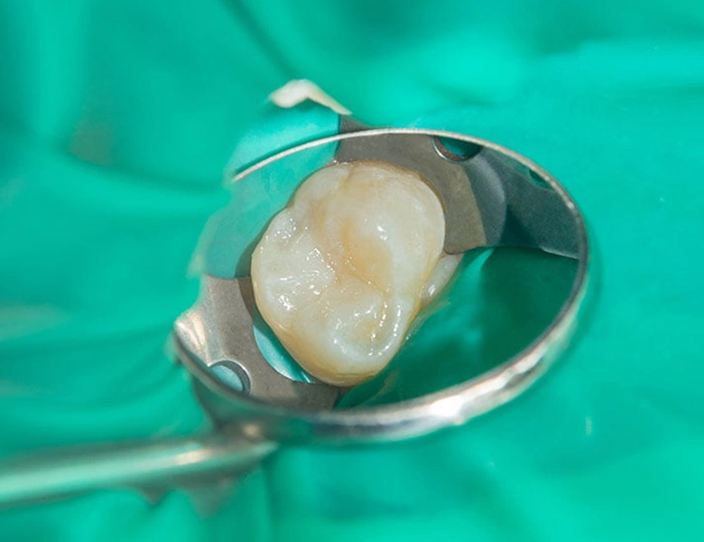 茗荷谷駅徒歩2分の歯医者｜佐藤歯科医院の根管治療